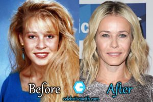 Chelsea Handler Plastic Surgery Facelift Boob Job Rumor Before After