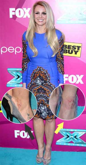 Britney Spears Psoriasis