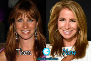 Jill Zarin Plastic Surgery, Facelift, Botox, Before and After Pics ...