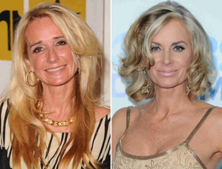 Kim Richards Before and After Plastic Surgery Including